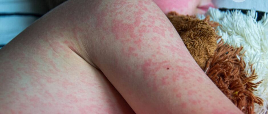 "Epidemia de sarampión: el PRI en el ojo del huracán, y la responsabilidad llega hasta la Presidencia"