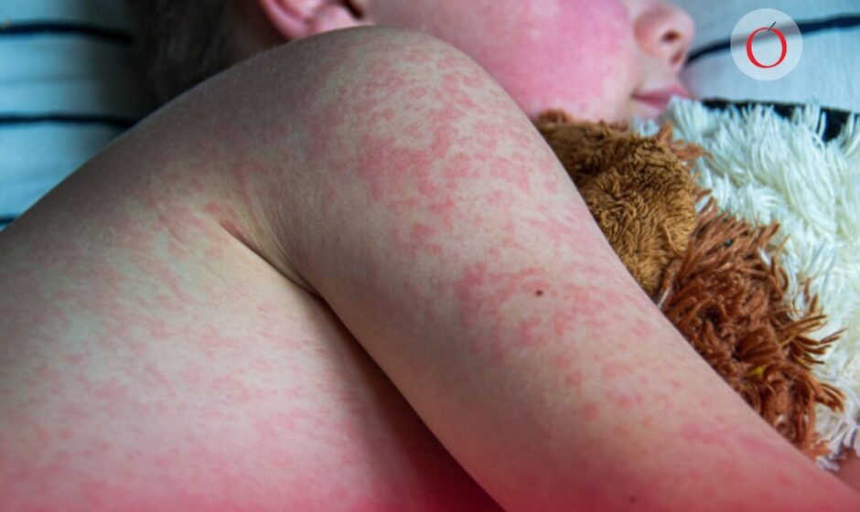 "Epidemia de sarampión: el PRI en el ojo del huracán, y la responsabilidad llega hasta la Presidencia"