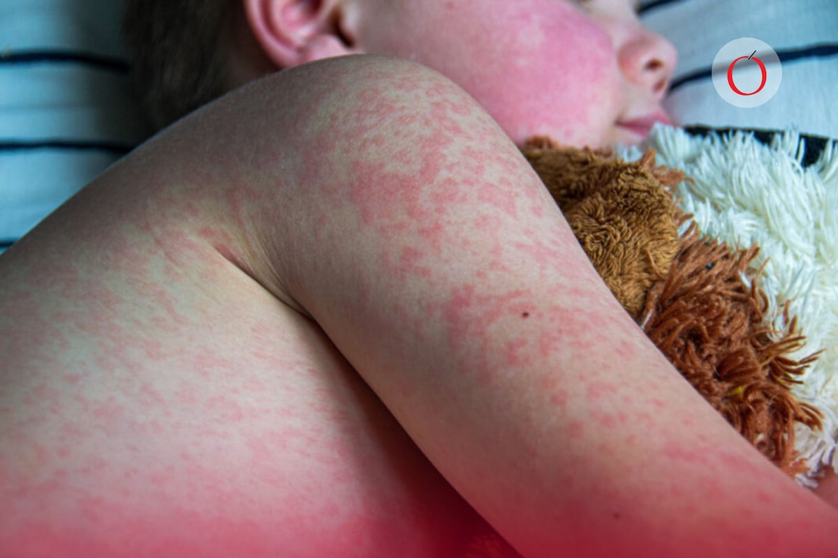 “Epidemia de sarampión: el PRI en el ojo del huracán, y la responsabilidad llega hasta la Presidencia”